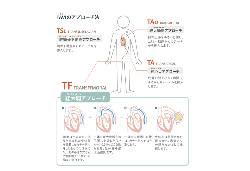 タビのアプローチ　心臓の病気の図