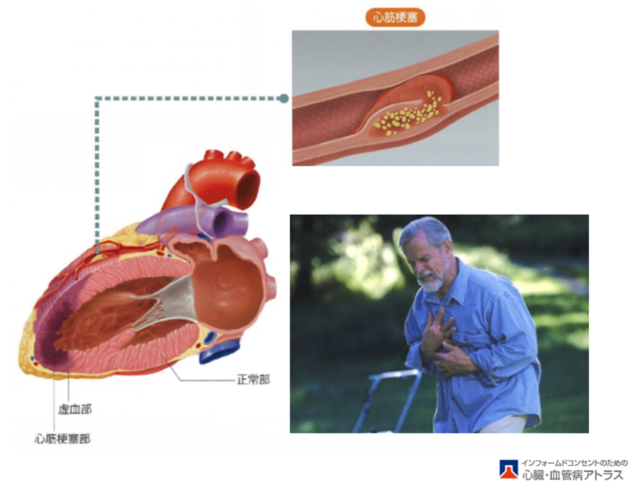 虚血性心疾患の話 – 佐賀大学医学部循環器内科
